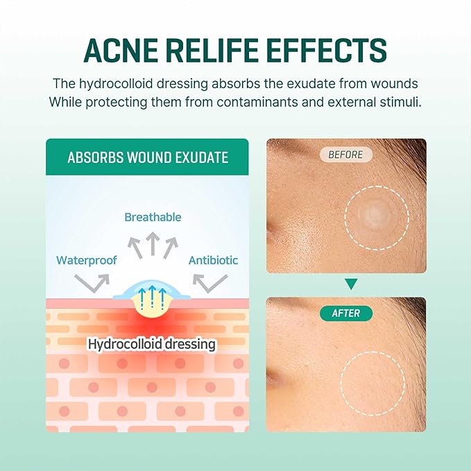 Clear Spot Patch – pleistrai spuogams