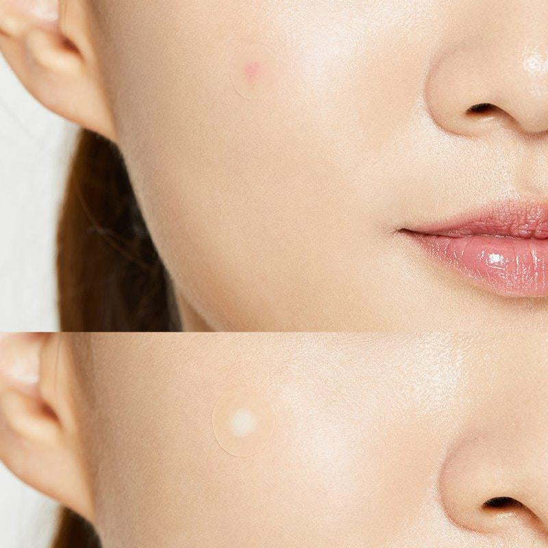 Acne Pimple Master Patch  - pleistrai spuogams