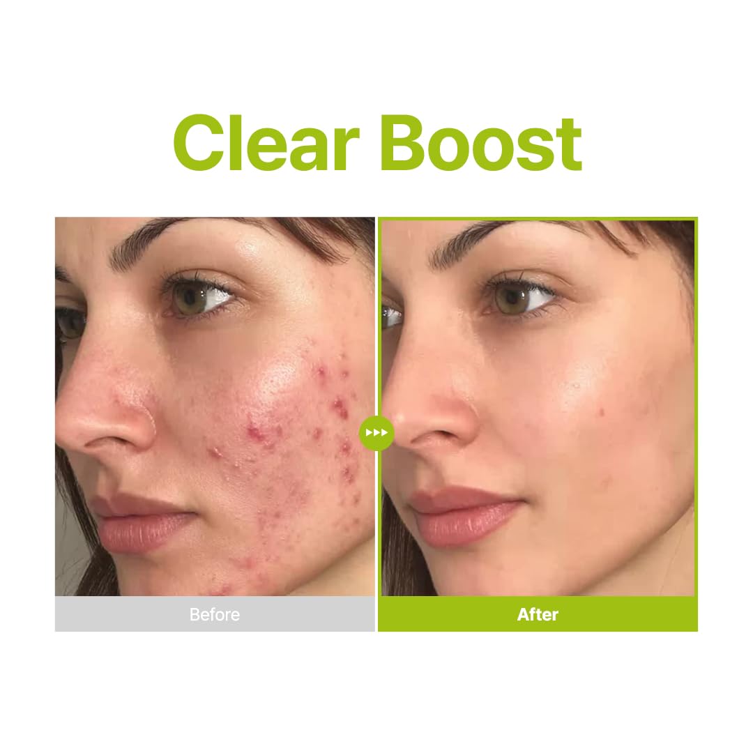 PURITO SEOUL Azelaic Acid 10 Kojic Tea Tree Serum – veido serumas