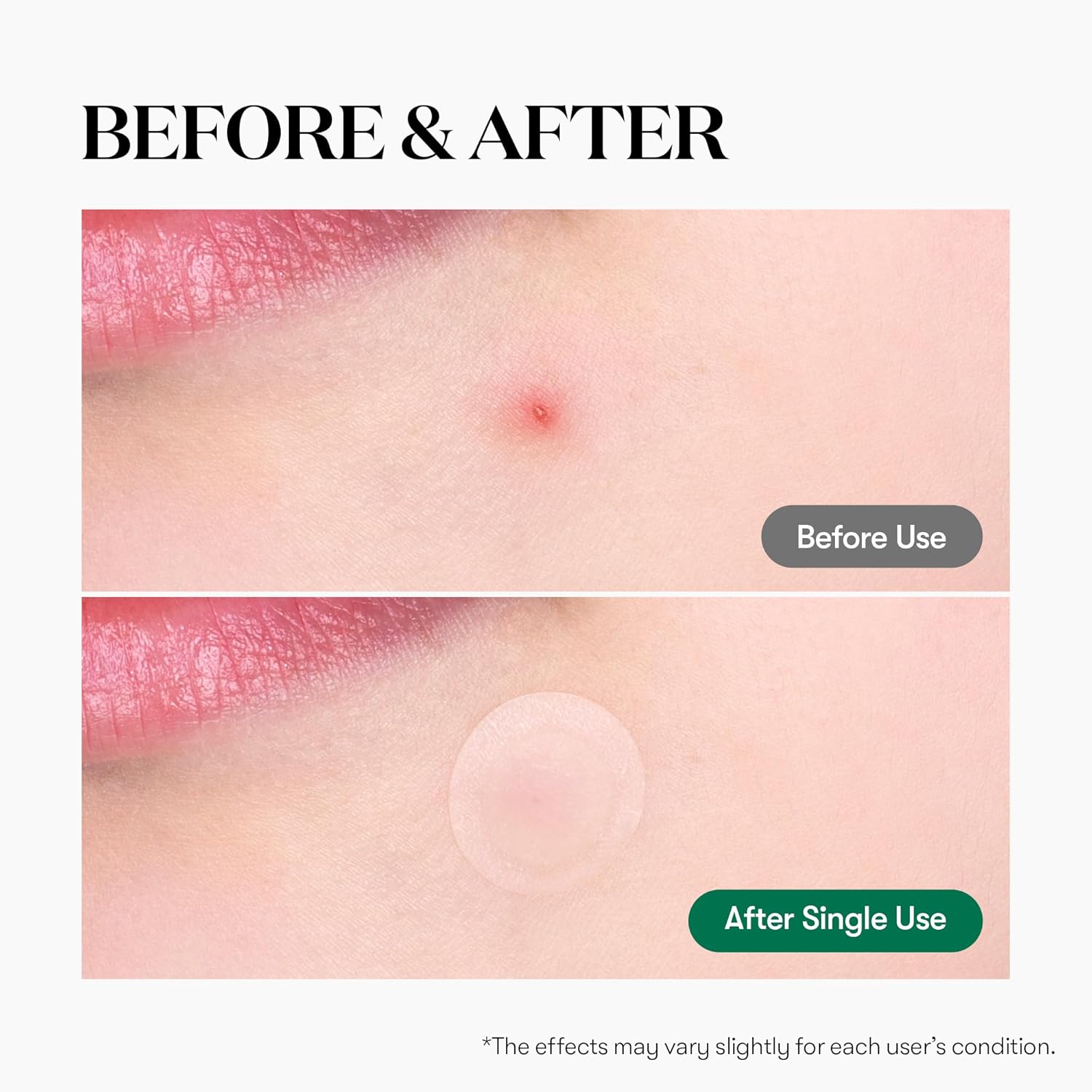 VT COSMETICS Cica Spot Patch – hidrokoloidiniai pleistrai spuogams su CICA (48 vnt)
